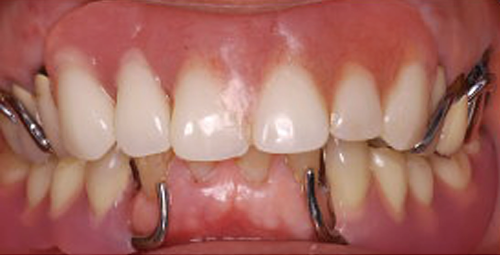 金属のバネ（クラスプ）が目立ってしまう保険適用入れ歯の装着写真