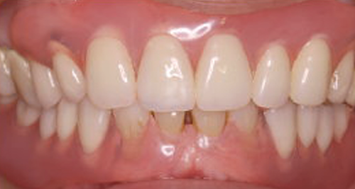 金属バネ不使用で審美性に優れたスマイルデンチャーの全体写真