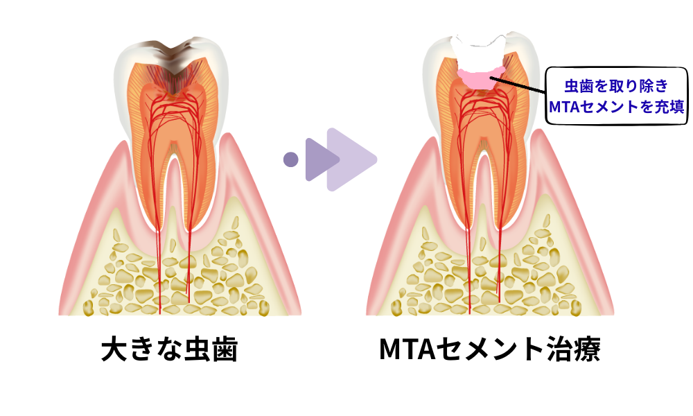 神経を抜かずに歯を保存するMTAセメント治療の作用メカニズムイラスト