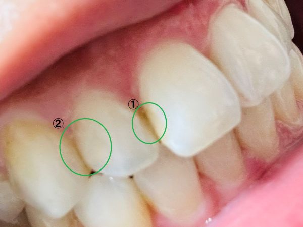 自費の白い詰め物
