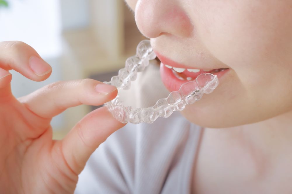 ホームホワイトニングのためにマウスピースを装着しようとする女性