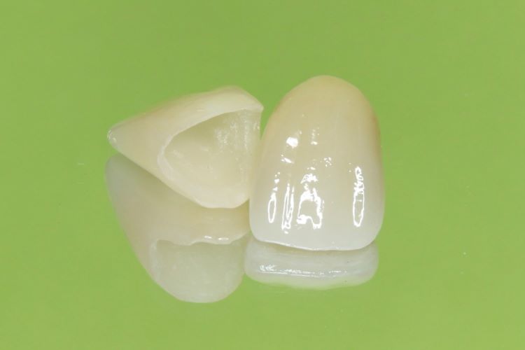 天然歯に近い色で審美性に優れたセラミックのかぶせ物