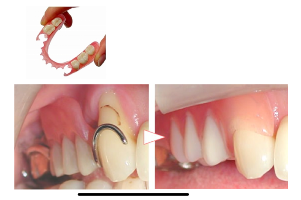 金属のバネが目立ってしまう保険適用入れ歯の装着写真とスマイルデンチャー装着後の写真