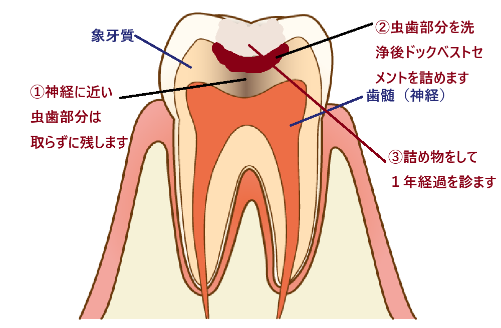 神経を残し、抗菌作用で虫歯を殺菌するドックベストセメント治療の説明図