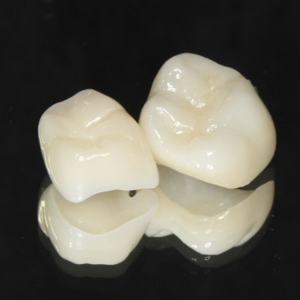 審美歯科でいれる審美性と機能性に優れた詰め物