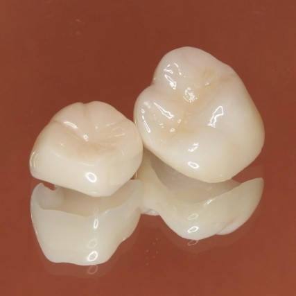 保険診療では難しい、審美性と機能性に優れたセラミックの詰め物
