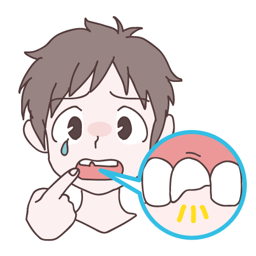 歯が欠けたり詰め物が取れたりした状態を示すイラスト