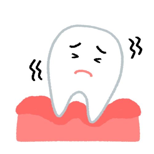 歯周病・歯槽膿漏の進行により歯がグラグラする状態を示すイラスト