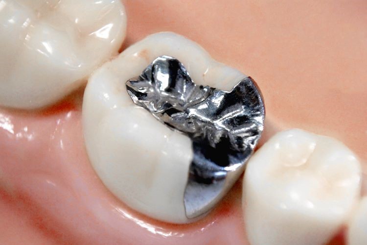 保険適用となる金属製の銀歯（インレー）の装着写真"