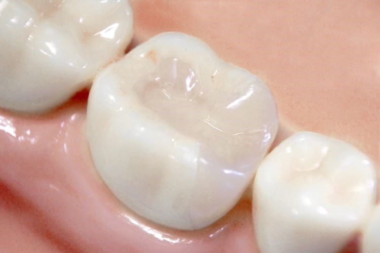 天然歯に近い色で審美性に優れたセラミックの詰め物（インレー）