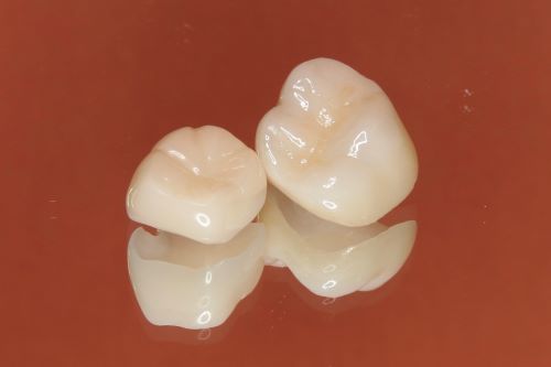 保険診療でも一部の部位で白い詰め物（CAD/CAM冠など）が選択できるイメージ写真