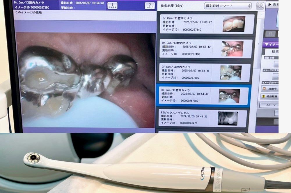 患者様の口内の状態を一緒に確認できる小型の口腔内カメラ