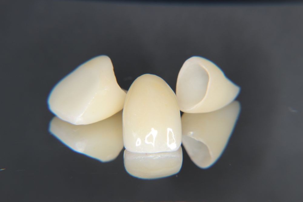 各種審美歯科のかぶせ物についてのリンクを補完する画像