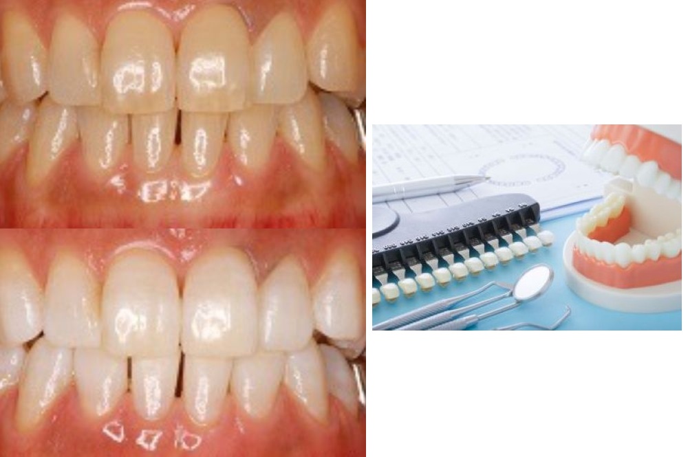 カラーチャートの比較と治療前後で劇的に改善した歯のビフォーアフター写真